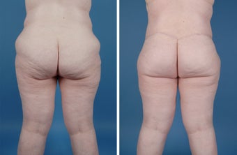 Lower Body Lift 303700
