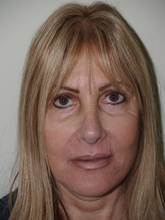 Revision Rhinoplasty 303872