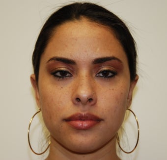 Otoplasty after 320201