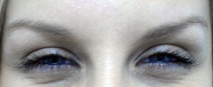 BOTOX Cosmetic after 566677