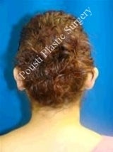 Ear Surgery (Otoplasty) before 584556