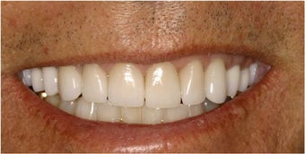 Porcelain Veneers after 112067