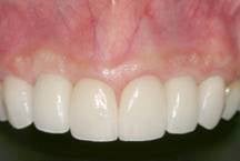 Congenital missing teeth and implants after 274782