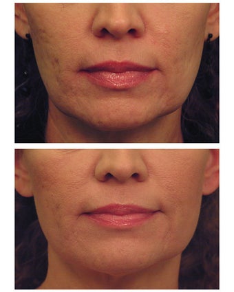 YAG Laser Skin Tightening before 490522