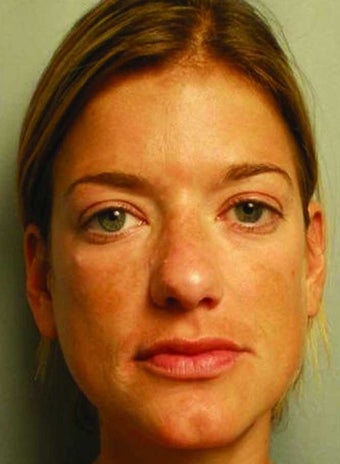 Radiesse injections after 349807