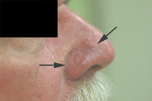 Vein removal on the nose with laser treatments after 106549