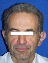 Ear Surgery (Otoplasty) before 357660