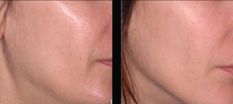 Ultherapy before 460625