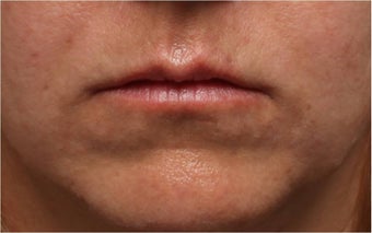 Restylane 444317