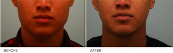 Botox Jaw Reduction before 375286