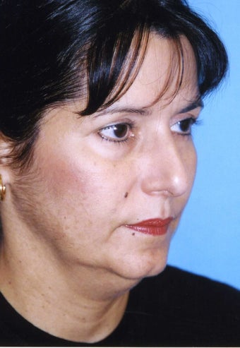 Chin Implant 409957
