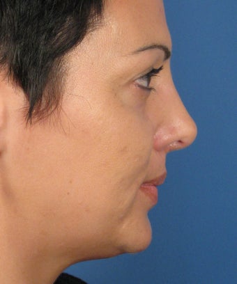 Revision Rhinoplasty 410783