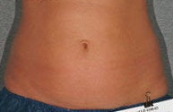 Liposonix before 582710