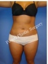 Liposuction after 632168