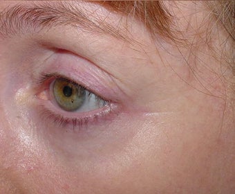 Affirm treatment of eye area wrinkles (crowsfeet) after 109815