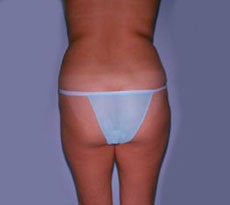 Smartlipo before 401661