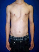 Pectus Excavatum, Chest Wall Reconstruction Surgery before 145940