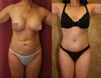 tummy tuck before 304698