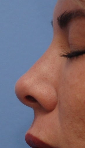 Non-Surgical Rhinoplasty after 182604
