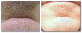 Radiesse to fill in chin crease before 6543