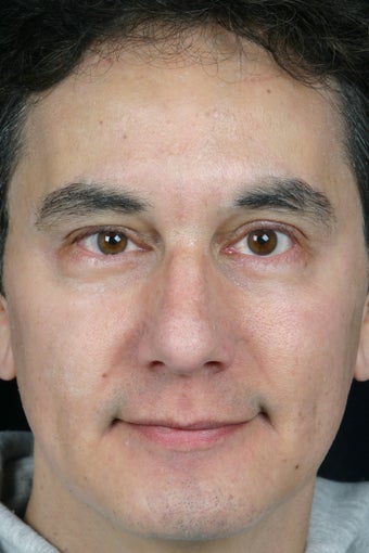 Pearl, Botox and Juvederm to Glabella (between eyes) after 308344