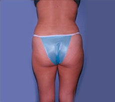 Smartlipo after 401661