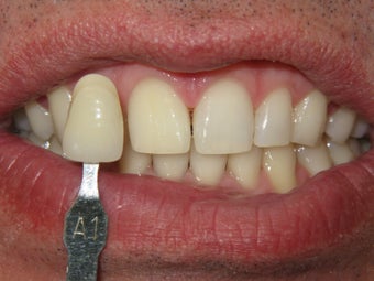 Whitening bleach trays after 348012