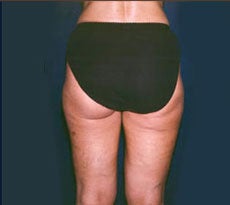 Smartlipo after 401658