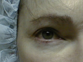 Mixto Fractionated Laser Resurfacing Treatment before 586423