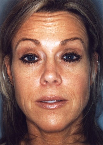Botox after 628889