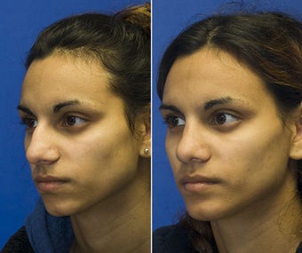 Chin Implantation with Rhinoplasty after 295372