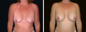 35 year old female, breast augmentation, San Francisco, California before 628367