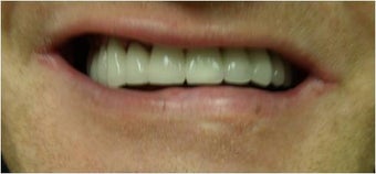 Full mouth Rehabilitation (Smile Makeover) after 390179