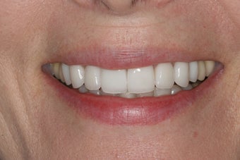 Porcelain Veneers after 213079