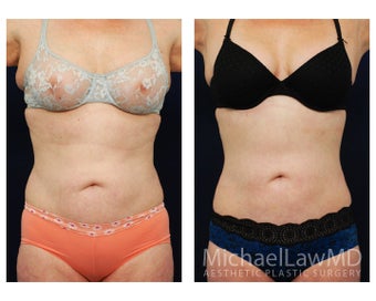 Liposuction before 629035