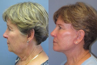 Lite lift, Neck Lift, Brow Lift after 523475
