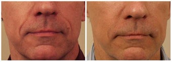 Restylane to Smile Lines before 480650