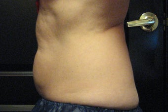 Zeltiq CoolSculpting 504019