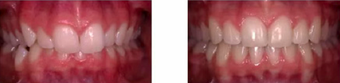 Over-bite corrected with braces before 300673