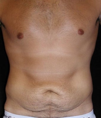 Male tummy Tuck, Flank Liposuction before 578169