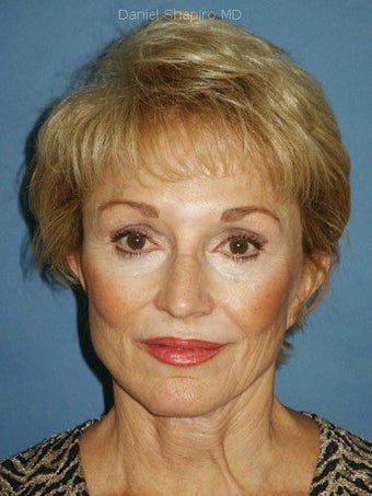 Chin augmentation with facial rejuvenation after 250159