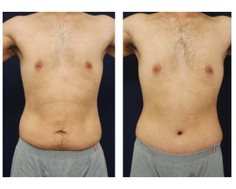 Abdominoplasty - Tummy Tuck before 396153