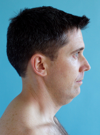Neck Lift before 229647