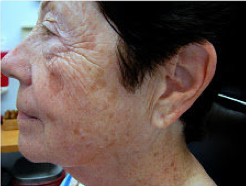 Fractional laser therapy before 460039