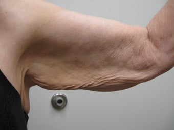 Arm Lift before 389009