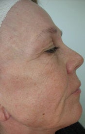 Wrinkle Removal before 550454