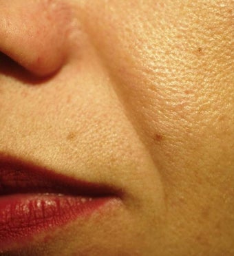 Sculptra before 184973