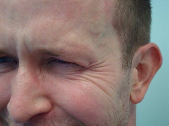 Botox- Crow's Feet before 610484