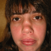 Revision Rhinoplasty before 443001