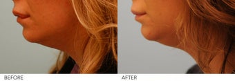 Lip Reduction before 245417